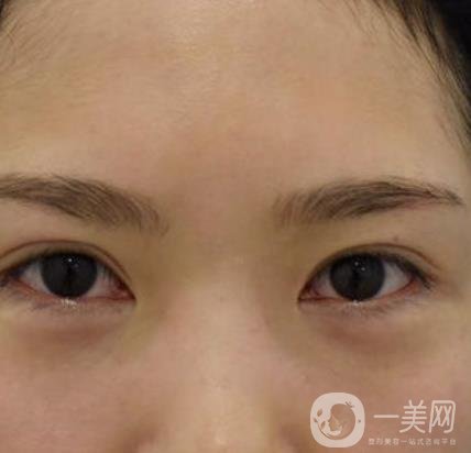 廣州人民醫(yī)院整形價格表，附去眼袋案例