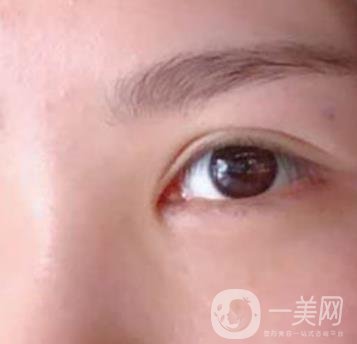 廣州人民醫(yī)院整形價格表，附去眼袋案例