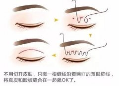 雙眼皮成型方法有哪些？好處有啥？