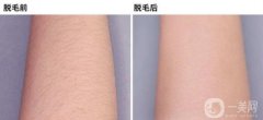 激光手臂脫毛之后會(huì)不會(huì)在長(zhǎng)？專家揭秘脫毛的優(yōu)點(diǎn)