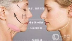 打了“*”就能消除魚尾紋！注射之前先了解這些幾點(diǎn)
