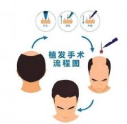 植發(fā)前需要注意哪些細(xì)節(jié)！看完漲知識(shí)了