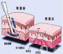 大腿吸脂手術(shù)多久可以恢復