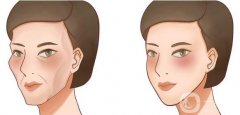 如何改良面部凹陷?玻尿酸填充面部怎么樣?