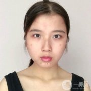 廣東省人民醫(yī)院整形科鄺石峰醫(yī)生脂肪填充案例_價格收費表一覽