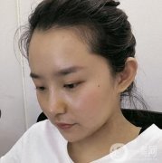 上海九院丁偉醫(yī)生隆鼻咋樣？收費貴嗎？看價格收費表&案例深入了解