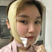 湘雅三醫(yī)院整形科價格表全新出爐！磨骨案例果圖同步公開~