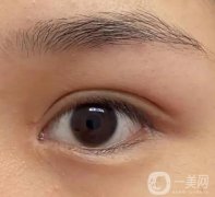 雙眼皮手術(shù)需要多久才能恢復(fù)呢?影響腫脹的因素有哪些?