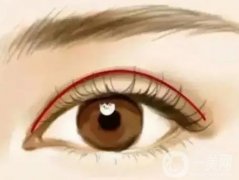 北京雙眼皮手術(shù)價格?哪些人不能做割雙眼皮呢?