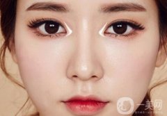 開內(nèi)眥后多久才能恢復(fù)呢？能維持多久？