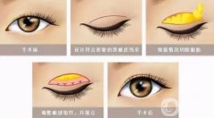 雙眼皮價(jià)格不一樣是怎么回事?雙眼皮多久能恢復(fù)自然?