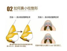 鼻小柱延長會不會漏出鼻孔？延長鼻小柱的方法有哪些？