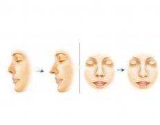 鼻小柱延長失敗如何修復(fù)？術(shù)后可能出現(xiàn)的風(fēng)險？