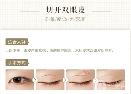 天津璦珊整形醫(yī)院雙眼皮整形日記_價格表介紹一覽