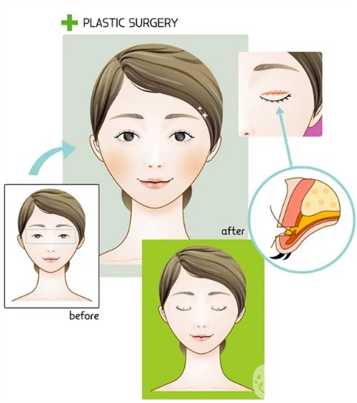 天津璦珊整形醫(yī)院雙眼皮整形日記_價格表介紹一覽