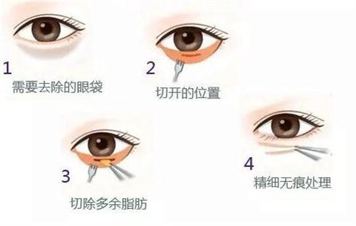 天津公安醫(yī)院整形價(jià)格表2020年，內(nèi)附做眼袋*圖