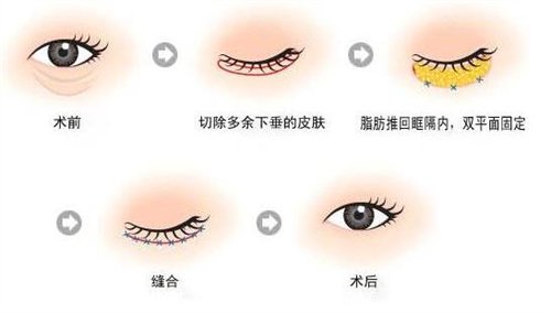 天津公安醫(yī)院整形價(jià)格表2020年，內(nèi)附做眼袋*圖