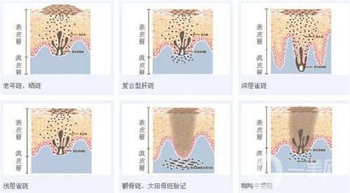天津醫(yī)科大學(xué)腫瘤醫(yī)院整形科價格表，附激光祛斑恢復(fù)*果圖