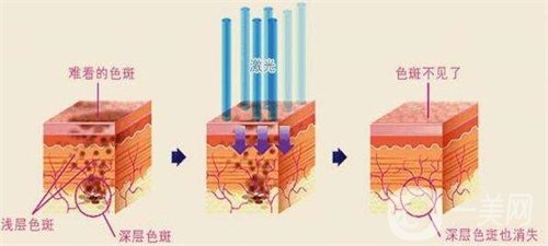 天津醫(yī)科大學(xué)腫瘤醫(yī)院整形科價格表，附激光祛斑恢復(fù)*果圖