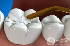 補牙是不是*性的？可以維持多久？