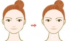 下頜角做截骨術(shù)要戴頭套的原因是什么？