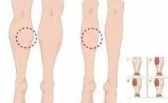 小腿抽脂后凹凸不平怎么辦？