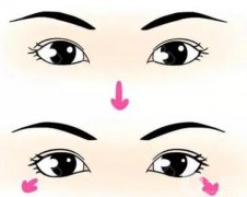 下眼瞼手術(shù)有哪些風(fēng)險？