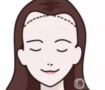 脫發(fā)際線產(chǎn)生的副作用如何避免？