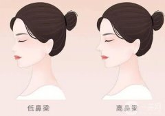 假體隆鼻對(duì)人體有害嗎?隆鼻后假體變化大嗎?