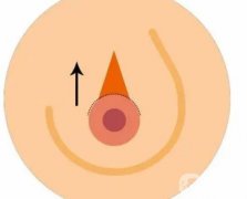 乳暈手術(shù)的特點(diǎn)是什么?需要注意哪些事項(xiàng)？