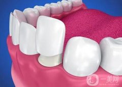 做了烤瓷牙可以做核磁共振嗎？