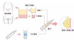 自體脂肪和脂肪膠的區(qū)別是什么？