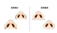 怎么避免鼻翼縮小的后遺癥？