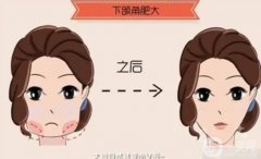 適合磨骨瘦臉的人群有哪些？
