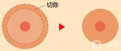乳暈縮小手術(shù)對(duì)身體影響大不大？