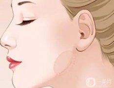下頜角整容疼嗎？果好嗎？