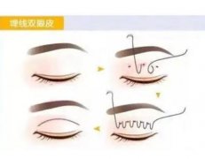 雙眼皮失敗的癥狀有哪些？