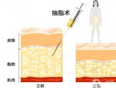 能在抽脂之后立即走路嗎？