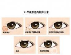 開眼角的疤痕怎么才能快速消失？開眼角疤痕多久能消除？