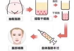 自體脂肪過度的填充應該怎么補救？