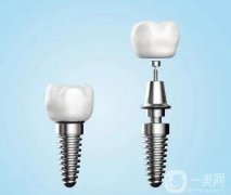 種植牙能使用多久與哪些因素有關(guān)？