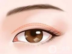 微創(chuàng)雙眼皮有什么特點？微創(chuàng)雙眼皮能維持多長時間?