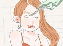 切眉有哪些常見的手術(shù)方法?