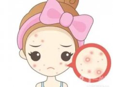 激光去痘痘要多少錢？