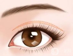 雙眼皮手術(shù)后拆線疼嗎？
