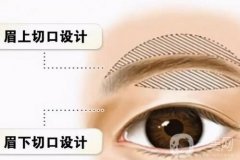 切眉失敗怎么辦，切眉可以做兩次嗎？