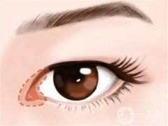 開眼角是否會導(dǎo)致疤痕？開眼角有哪些危害？