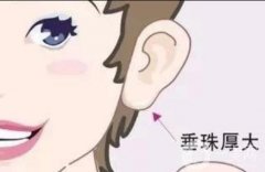 有哪些豐耳垂的方法？注射玻尿酸豐耳垂有什么注意事項?
