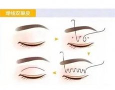 切開雙眼皮手術(shù)后怎么護理，有什么副作用