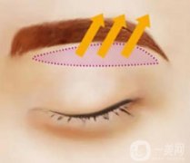 提眉術與切眉術的區(qū)別是什么?